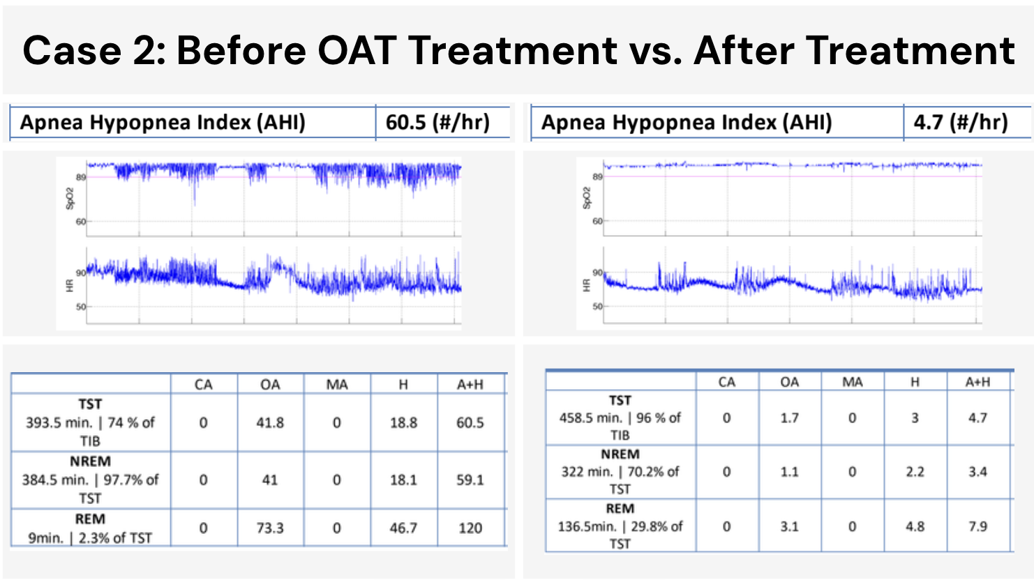 Driver B AHI before and after oral appliance therapy, dropping from 60.5 to 4.7